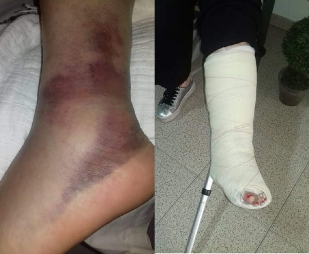 Comerciante fratura perónio em queda num passeio escorregadio perna